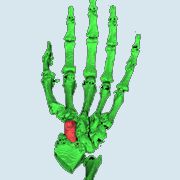 Segmentation, scaphoid bone, CT data, 3D Bioprinting